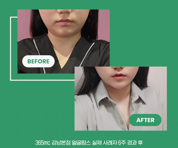 before after 365mc 얼굴람스 실제 사례자 